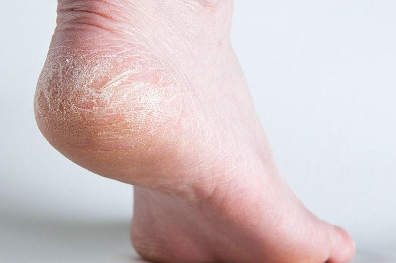 trị nứt gót chân bằng kem đánh răng